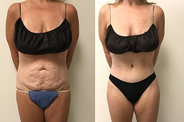 tummy tuck before and after