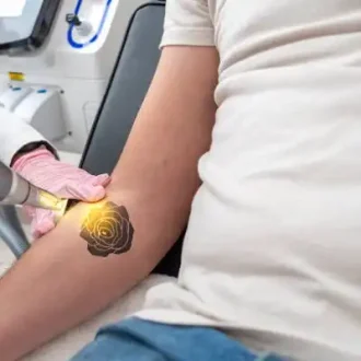 PicoSure Tattoo Removal vs PicoWay Tattoo Removal