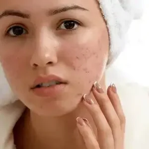 Best Acne Treatments for Clear Skin: What Really Works?