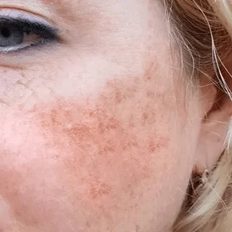 How To Get Rid Of Melasma Permanently in Riyadh