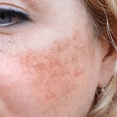 How To Get Rid Of Melasma Permanently in Riyadh