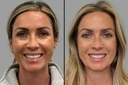 Anti-wrinkle Botox treatment