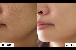 Before and After Large Pores Treatment in Riyadh