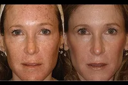 Best Large Pores Treatment Before After in Riyadh