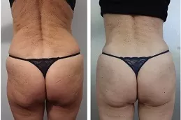 Body Filler Injections Riyadh