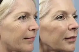Botox for wrinkles