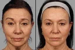 Botox injections for wrinkles