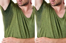 Botox underarm sweating before and after results