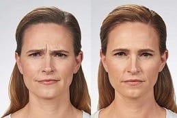 Botox wrinkle treatment
