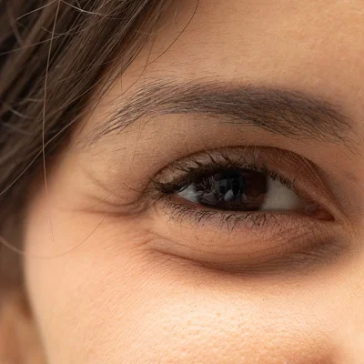 Can Eye Bags Return After Blepharoplasty in Riyadh