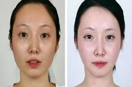 Chin Fat Removal Riyadh