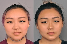 Chin Liposuction Riyadh