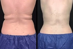 CoolSculpting before and after
