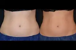 CoolSculpting fat freezing before after Photos