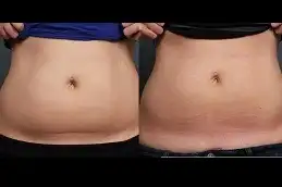 CoolSculpting fat freezing before after