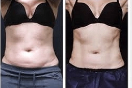 CoolSculpting results before after