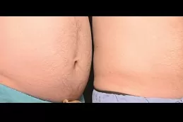 CoolSculpting transformation before after
