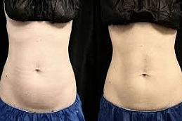 CoolSculpting treatment before after