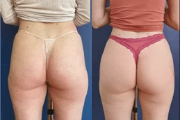 Dermal Body Fillers Riyadh
