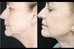 Double chin before and after results