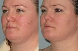 Double chin reduction before after