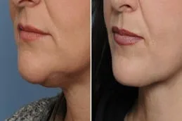 Double chin transformation before after