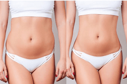 Fat Burning Injections Riyadh