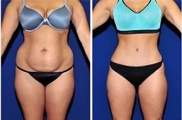 Fat Dissolving Injections Riyadh
