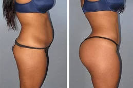 Fat Melting Injections Riyadh