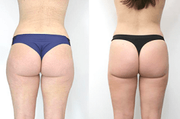 Fat Reduction Injections Riyadh