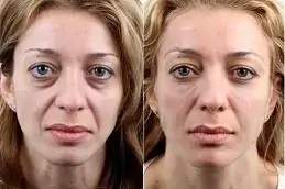 Fillers for under eyes