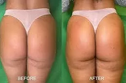 Injectable Body Fillers Riyadh