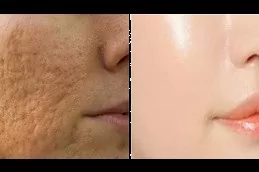Large Pore Reduction Treatment Before After