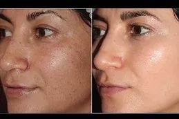 Large Pores Laser Treatment Riyadh Before and After