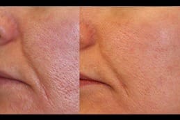 Large Pores Removal Treatment Before After in Riyadh