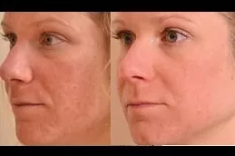 Large Pores Treatment Riyadh Before After