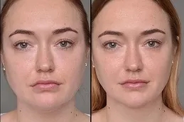 Mesotherapy before and after