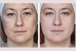 Mesotherapy results before and after