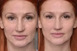 Mesotherapy skin treatment before after