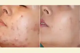 Mesotherapy transformation before after