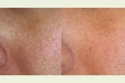 Mesotherapy treatment before and after