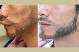 Mustache Hair Transplant before after results
