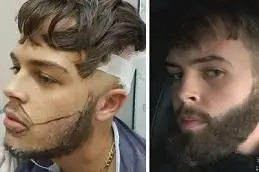 Mustache Hair Transplant results
