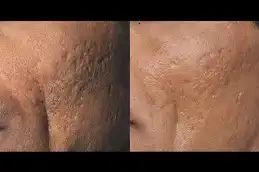 Pico laser before after photos