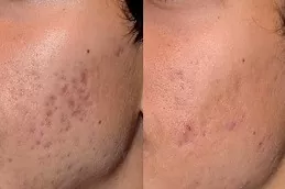 Pico laser results photos