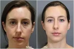 Tear trough filler treatment
