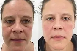 Under eye dermal fillers