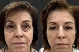 Under eye filler injections