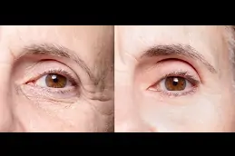 Under-eye filler treatment riyadh