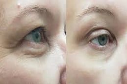 Under-eye filler treatment
